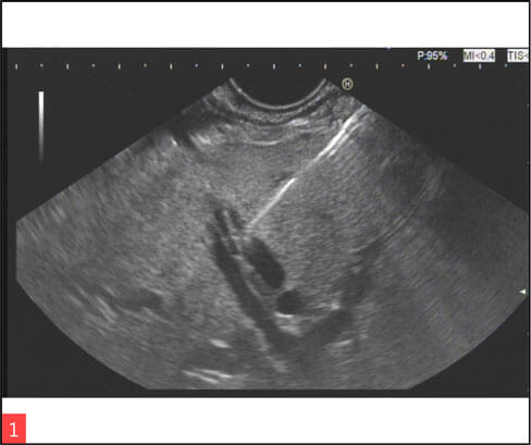 Endoscopic ultrasound guided hepaticogastrostomy (EUS HGS) Image 1