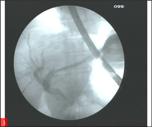 Endoscopic ultrasound guided hepaticogastrostomy (EUS HGS) Image 3