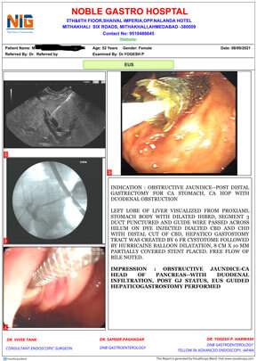 Endoscopic ultrasound guided hepaticogastrostomy (EUS HGS) Image 6