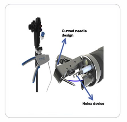 best Endoscopic Sleeve Gastroplasty (ESG) in Ahmedabad, Gujarat, India, Paldi, Naroda, Bapunagar, Nikol, Odhav, Vastral, Saraspur, Ellis bridge, endoscopic sleeve gastroplasty doctors near me, best endoscopic sleeve gastroplasty(ESG) doctors india, gastroplasty sleeve hospital in india